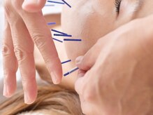 あすか鍼灸整骨院 アスカボディファクトリー(ASUKABodyFactory)/小顔・艶肌へ美容鍼