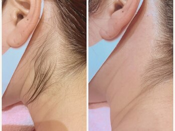 レネットサロン(Reinette Salon)/うなじワックス脱毛