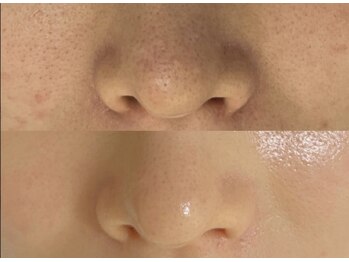 美門/水光肌に導くセラピール