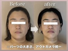 ジェイミー(Gemiey)の雰囲気（家族も驚く！別人級な小顔効果！フェイスラインも激変ですね♪）