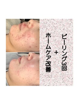 エステティックサロン S/ニキビケア、跡ケアにも期待大！