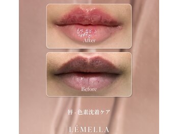 プリマプリート 可児店の写真/韓国発★最新黒ずみケア【LEMELLA】で肌本来の自然な美しさへ。着色料不使用◎無料カウンセリング受付中！