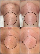 毛穴専科/毛穴洗浄+白玉ワックス メンズ◎