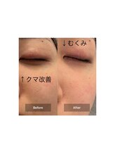 ルミエール(Lumiere)/２０代女性クマ、むくみのお悩み