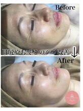 メールアンテリュール 神楽坂店/激変！！顔筋小顔フェイシャル