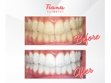 ティアナ 高知店(Tiana)の雰囲気（Before & After(セルフホワイトニング））