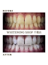 ホワイトニングショップ 千葉店/歯科提携　ホワイトニング専門店