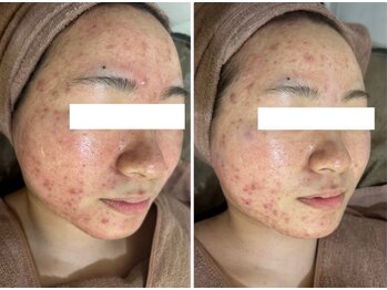 ホワイトアクア 四日市店(WHITE AQUA)/ニキビ改善/韓国肌管理/シワ改善