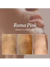 ヨウン 大阪心斎橋(yeoun)/ローマピンク大阪/メラニンケア