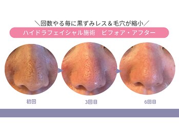 もみほぐし～ぷカンバラ(KAMBARA)の写真/毛穴レス肌へ！独自手技で黒ずみ対策◎根こそぎお掃除する結果だしエステ体験♪