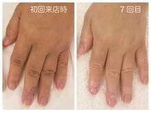 キレイテ 上野店/50代/7回目【東京ハンドケア】