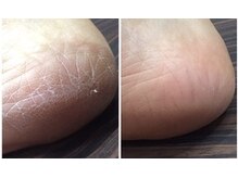 ビービーネイル(BB)/ツルツル角質ケア