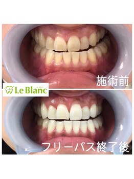ルブラン 奈良店(Le Blanc)/ホワイトニングはするべき!!