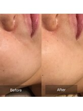 ファヴォリ(favori)/エイジング美肌美容液導入