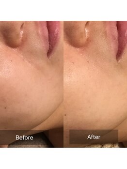 ファヴォリ(favori)/エイジング美肌美容液導入