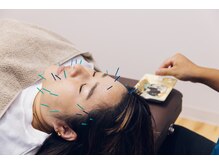 クガツヨッカ/◇美容鍼♪