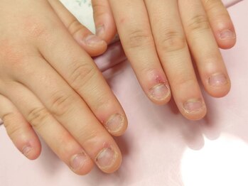 クリスタルネイル(CrystalNail)の写真/写真のような爪の方でも大丈夫です！【深爪矯正スカルプ】¥8000(オフ込)☆自爪のお悩み解決しましょう♪