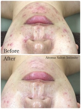 アンティミテ(Intimite)/ パーソナルスキンケアコース