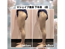 ルピナス ヒサヤ(LUPINUS hisaya)/Vシェイプ痩身