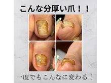 シャドウ(shadow)の雰囲気（こんなに分厚い肥厚爪も一度でここまで見た目綺麗に！！）