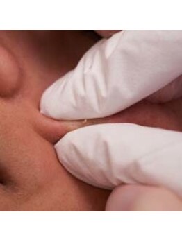 レディラック 大阪梅田本店(Lady Luck)/毛穴エクストラクション