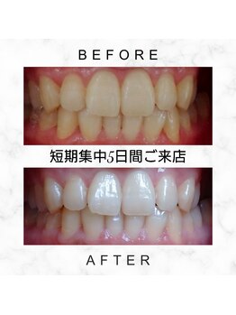 エミリアホワイトニング(EMIRIA WHITENING)/Before/After