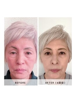 サロン レインボー(SALON RAINBOW)/小顔集中コース Before/After
