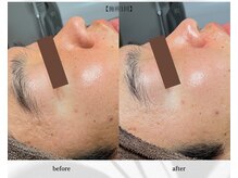 アン ビューティー(ann beauty)/施術1回【症例写真】20代