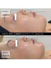 ケイリー(kaylee)/ハーブピーリング