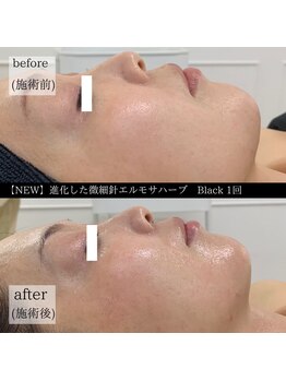 ケイリー(kaylee)/ハーブピーリング