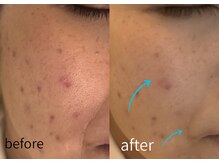 ルーム701(room701)/毛穴　たるみ　シワ　シミ