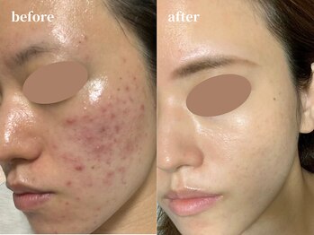 クレールアンジュ(ClairAnge)/フェイシャル人気NO.1メニュー