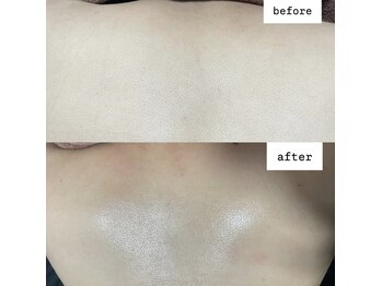 ウィズティ(with.T)/背中Wax+光脱毛