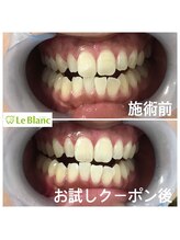 ルブラン 奈良店(Le Blanc)/1日30分で白く！！