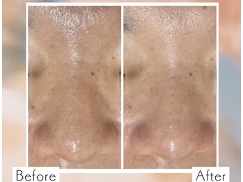 ディオーネ 上越南高田店(Dione)/毛穴洗浄&毛穴吸引