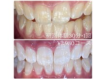 ホワイトニングルーム 横浜店(Whitening Room)/ホワイトニング/横浜