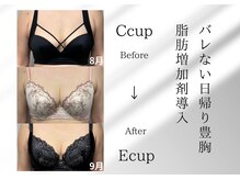 アールメディカルサロン 富山院(R Medical Salon)/脂肪定着バストアップ