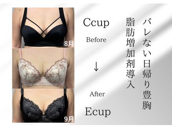 アールメディカルサロン 富山院(R Medical Salon)/脂肪定着バストアップ