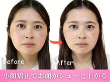 鍼灸整体院ワト 三軒茶屋院(鍼灸整体院WATO)/■小顔矯正（before→after）
