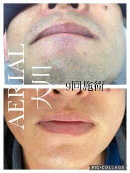 エアリアル 大川店/ヒゲ脱毛