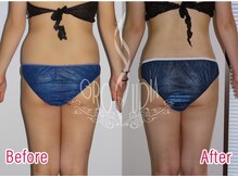 グラウディア 恵比寿/痩身/筋膜リリース/インディバ超