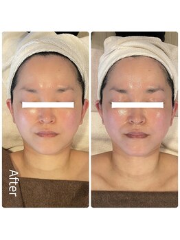 エクセレントビューティーサロン 艶(EN)/VENUSリフト　弛み・法令線予防