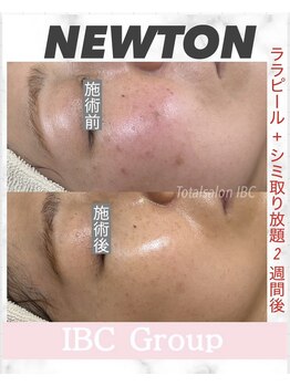 トータルサロンアイビーシー(トータルサロンIBC)/NEWTON シミケア