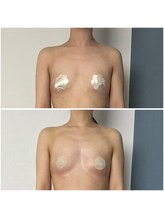 モア(moa)/3回目バストボリューム症例