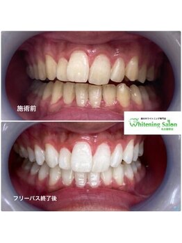 ホワイトニングサロン 名古屋駅店/【ホワイトニング施術例】