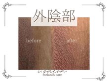 アイサロン(i.salon)の雰囲気(メラニンケア 外陰部)