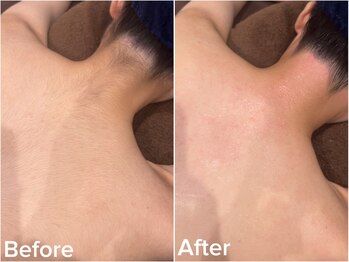 ジョエルワックス 沖縄那覇店(JOELLE WAX)/背面お手入れ♪うなじ+背中脱毛