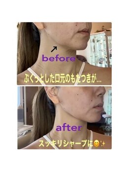 アリス 赤坂/究極リフトアップ