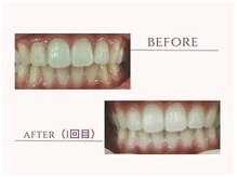 ラディアンス(Radiance+)/ 富山市メンズ◎ホワイトニング