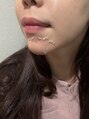 サロンソワ(salon 想和) 剥離ありのハーブピーリング大好きです。ニキビのご相談は是非!